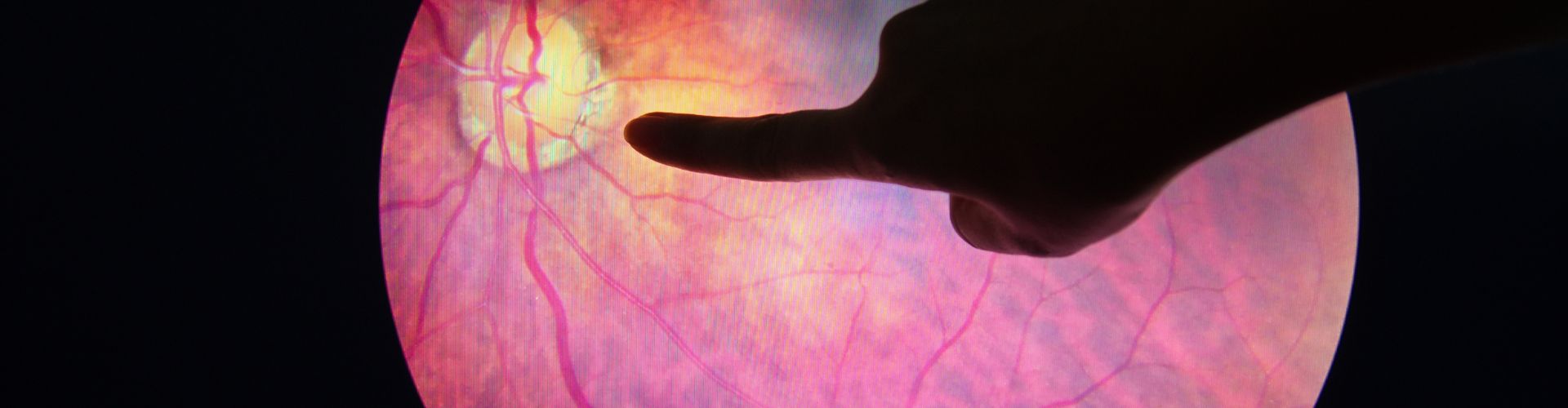 diabetic retinopathy
