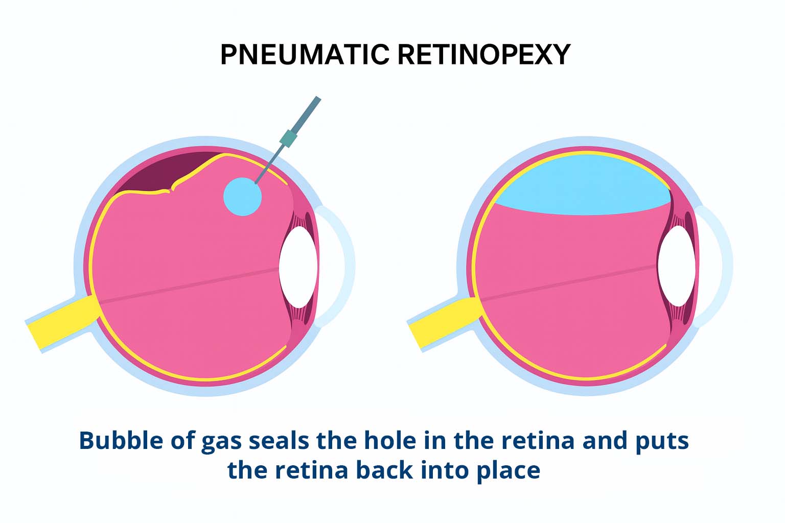 Pneumatic Retinopexy diagram from Teton Retinal Institute